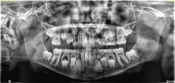 SISTEMA DE RADIOLOGÍA 2D/3D EXTRAORAL CARESTREAM 8100 3D - Imagen 8