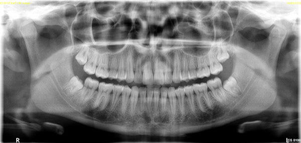 SISTEMA DE RADIOLOGÍA 2D/3D EXTRAORAL CARESTREAM 8100 3D - Imagen 7