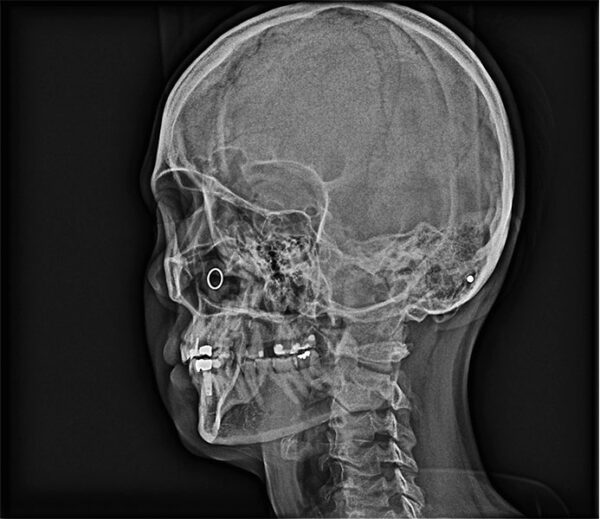 SISTEMA DE RADIOLOGÍA 2D/3D EXTRAORAL CARESTREAM CS 8100 SC 3D - Imagen 11
