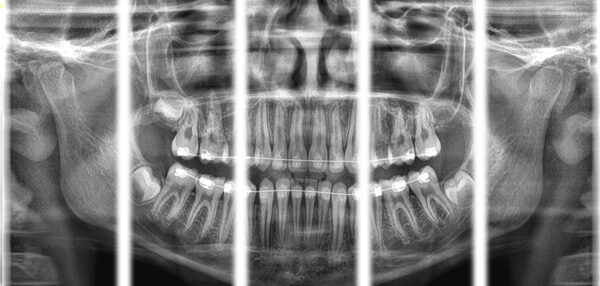 SISTEMA DE RADIOLOGÍA 2D/3D EXTRAORAL CARESTREAM 8100 3D - Imagen 5