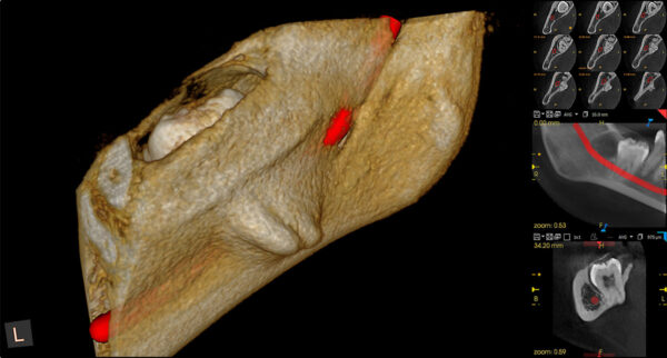 SISTEMA DE RADIOLOGÍA 2D/3D EXTRAORAL CARESTREAM CS 8100 SC 3D - Imagen 4
