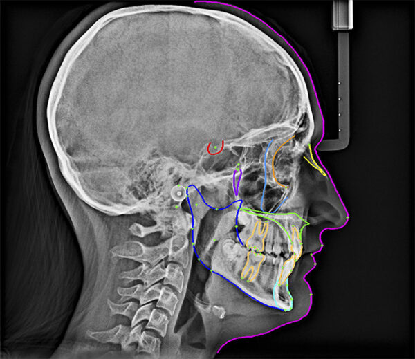 SISTEMA DE RADIOLOGÍA 2D/3D EXTRAORAL CARESTREAM CS 8100 SC 3D - Imagen 5