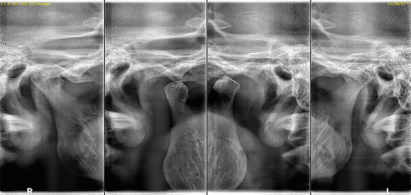 SISTEMA DE RADIOLOGÍA 2D/3D EXTRAORAL CARESTREAM 8100 3D - Imagen 6