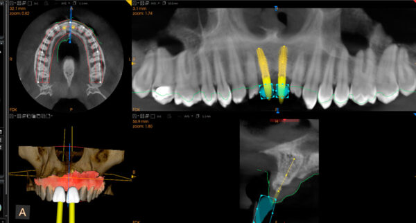 SISTEMA DE RADIOLOGÍA 2D/3D EXTRAORAL CARESTREAM CS 8100 SC 3D - Imagen 3