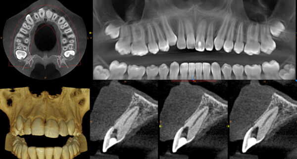 SISTEMA DE RADIOLOGÍA 2D/3D EXTRAORAL CARESTREAM CS 8100 SC 3D - Imagen 6