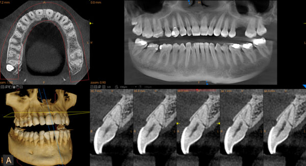 SISTEMA DE RADIOLOGÍA 2D/3D EXTRAORAL CARESTREAM CS 8100 SC 3D - Imagen 7
