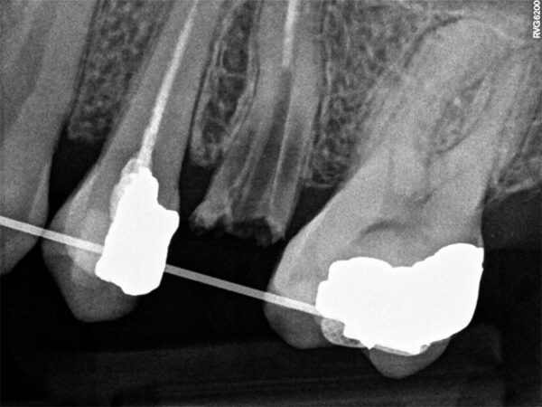SENSOR DE RADIOLOGÍA DIGITAL CARESTREAM RVG 6200 - Imagen 7