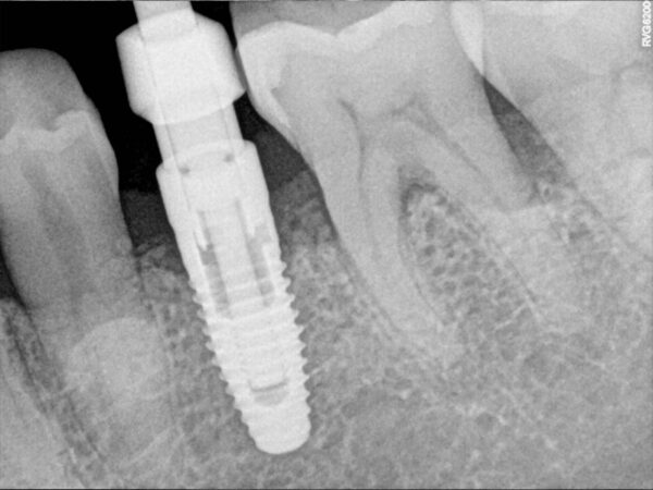 SENSOR DE RADIOLOGÍA DIGITAL CARESTREAM RVG 6200 - Imagen 5