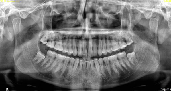 SISTEMA DE RADIOLOGÍA 2D/3D EXTRAORAL CARESTREAM CS 8100 SC 3D - Imagen 2